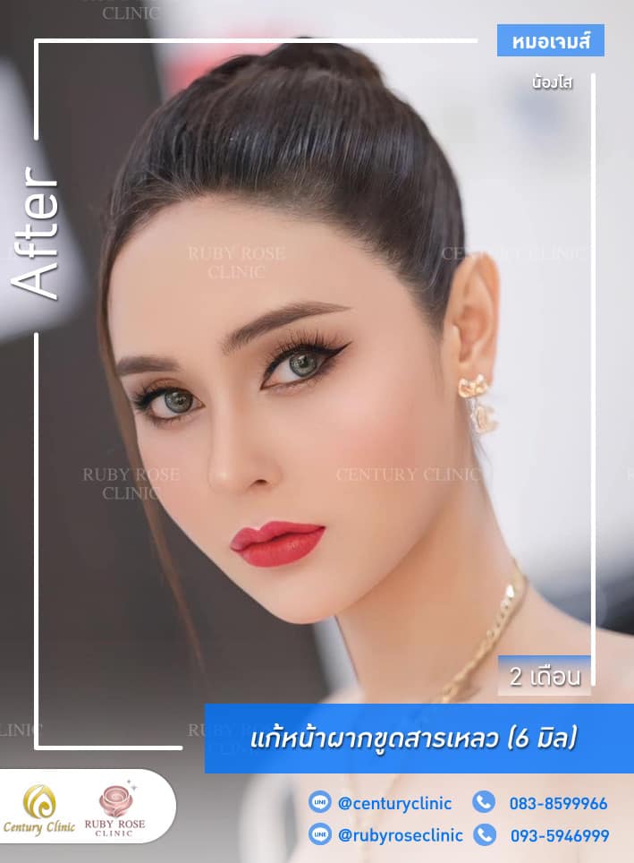Century รีวิว เสริมหน้าผากปรับโหวงเฮ้ง #18