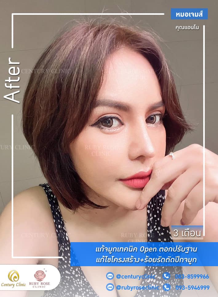 รีวิว แก้จมูก #283 , Century Clinic Thailand Century รีวิว แก้จมูก 1#283
