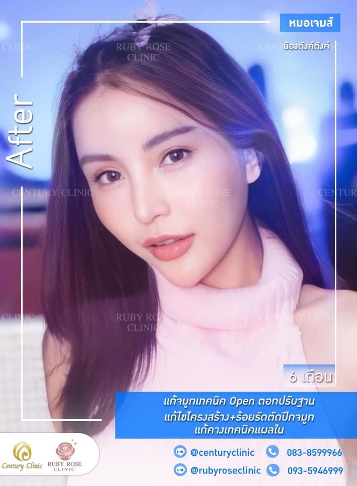 Century-รีวิว-แก้จมูก 1#298