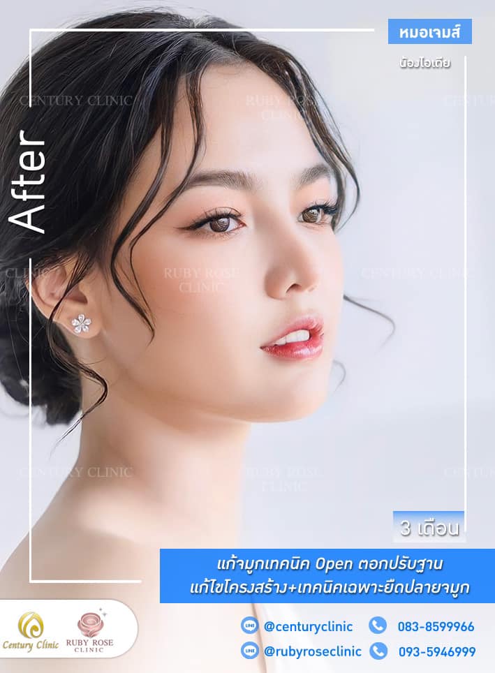 Century-รีวิว-แก้จมูก 1#305