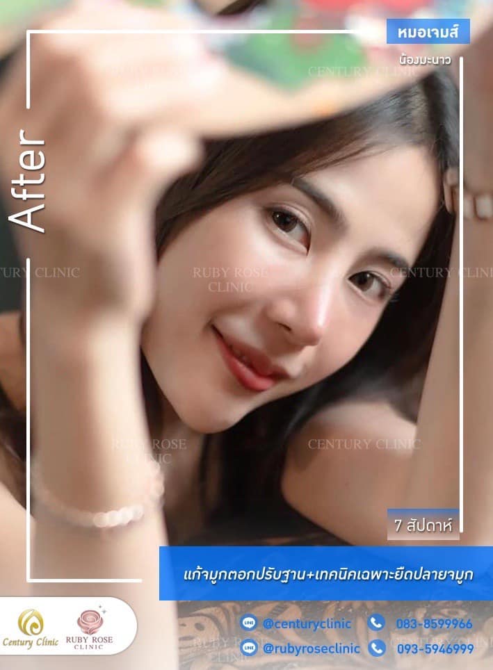 Century-รีวิว-แก้จมูก 1#314