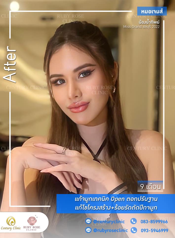 รีวิว แก้จมูก #317 , Century Clinic Thailand Century-รีวิว-แก้จมูก 1#317