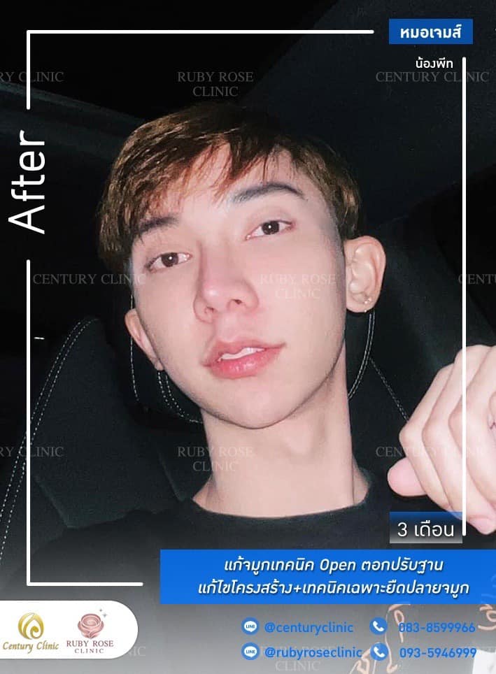 Century-รีวิว-แก้จมูก 1#322
