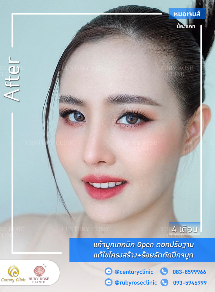 Century-รีวิว-แก้จมูก 1#329