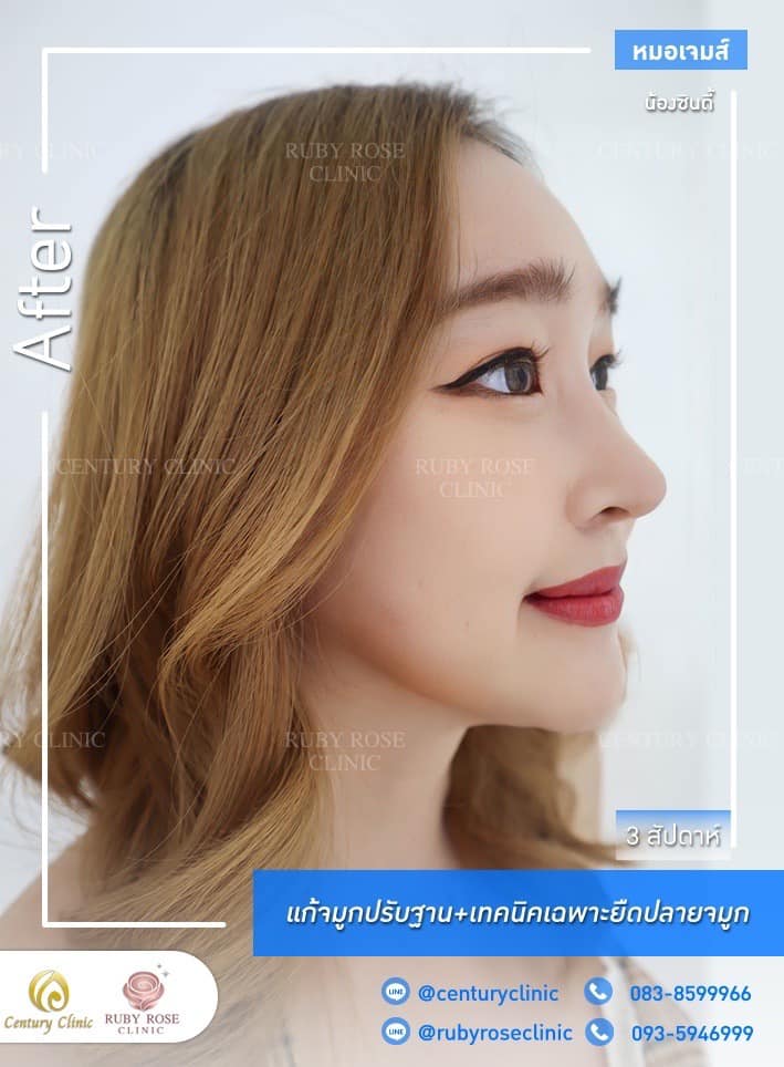 Century-รีวิว-แก้จมูก 1#352