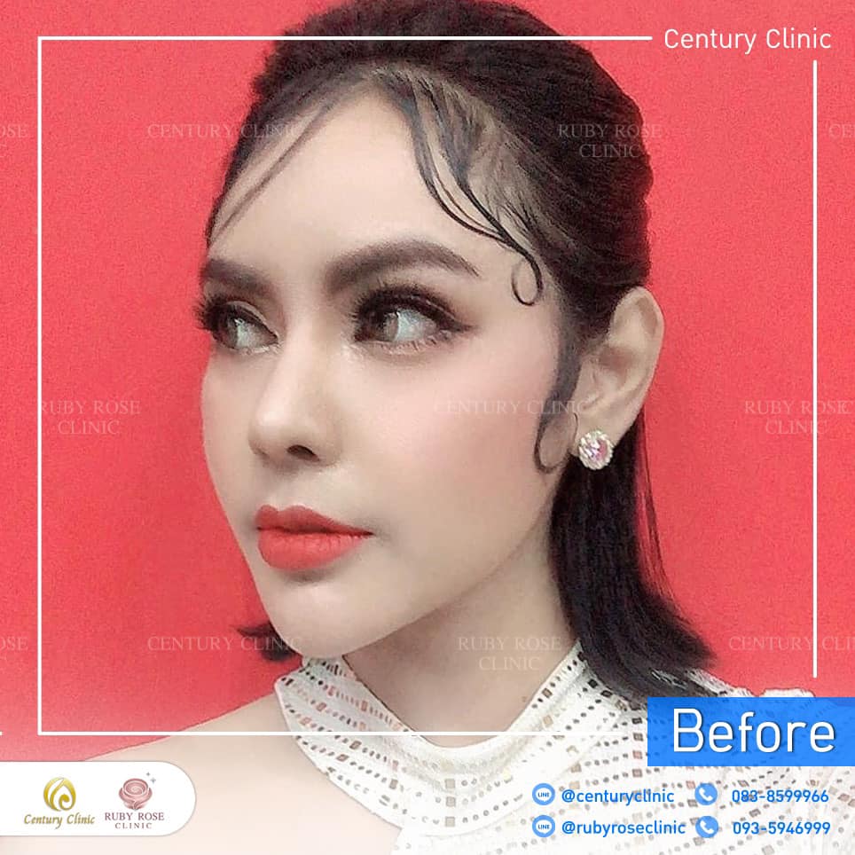 รีวิว แก้จมูก #283 , Century Clinic Thailand Century รีวิว แก้จมูก 2#283