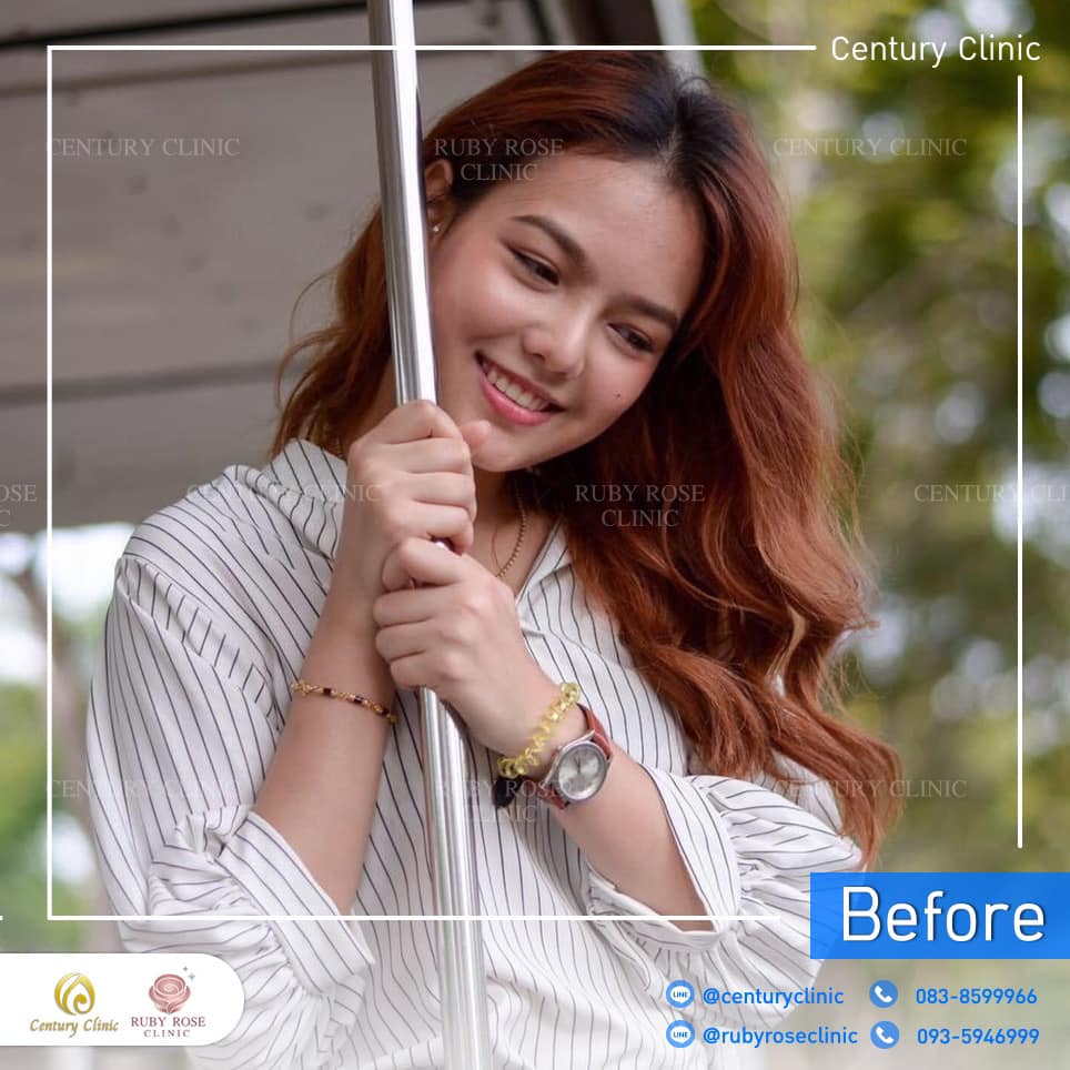 Century-รีวิว-แก้จมูก 2#305