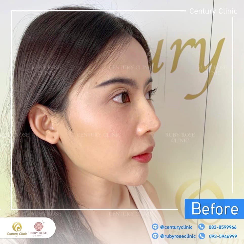 Century-รีวิว-แก้จมูก 2#314
