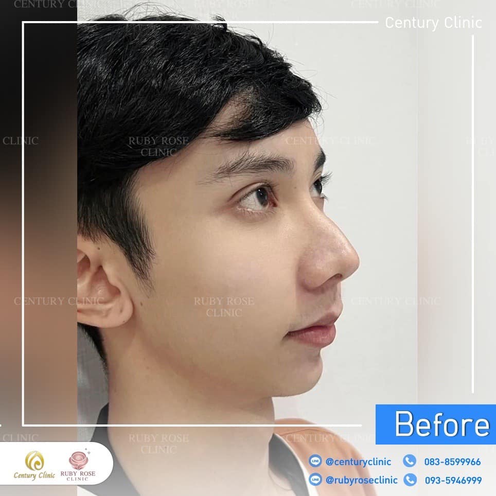 Century-รีวิว-แก้จมูก 2#322