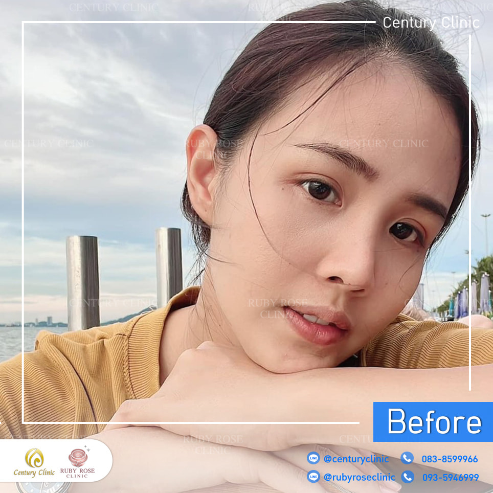 Century-รีวิว-แก้จมูก 2#329