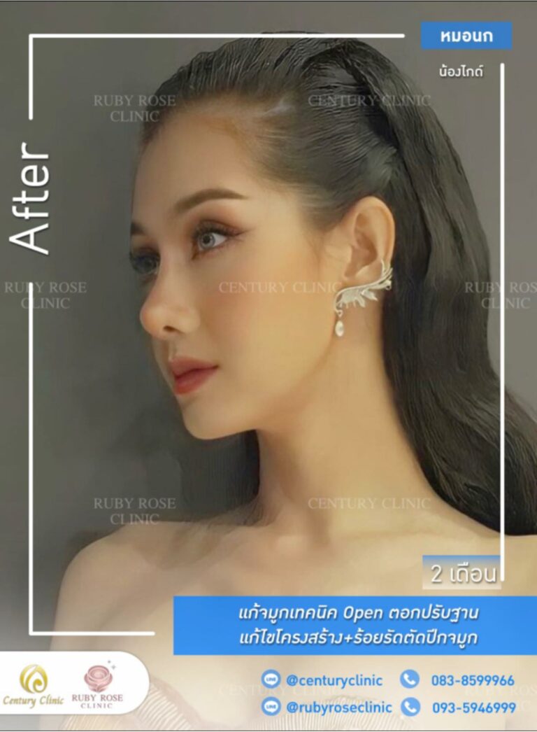 Century-รีวิว-แก้จมูก #295