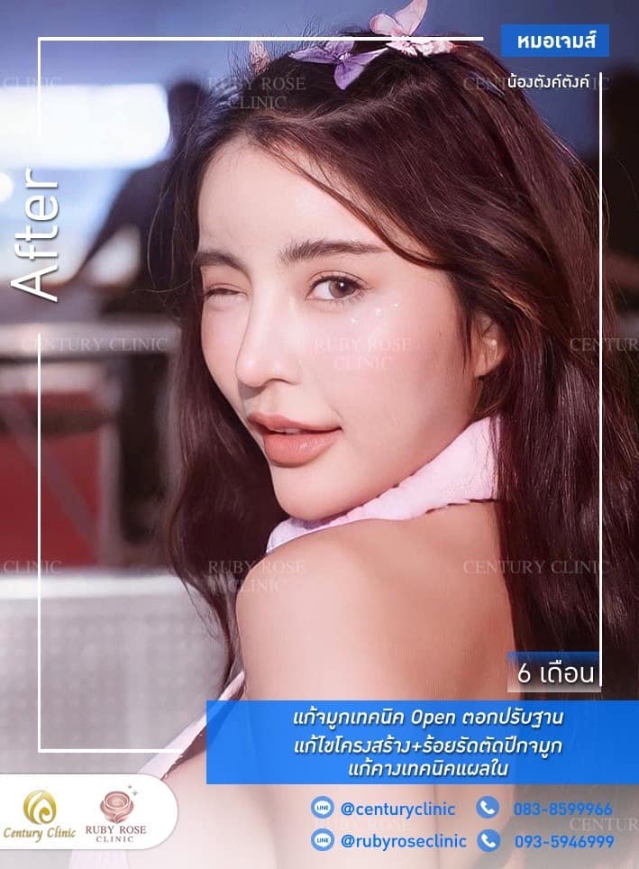 Century-รีวิว-แก้จมูก #298