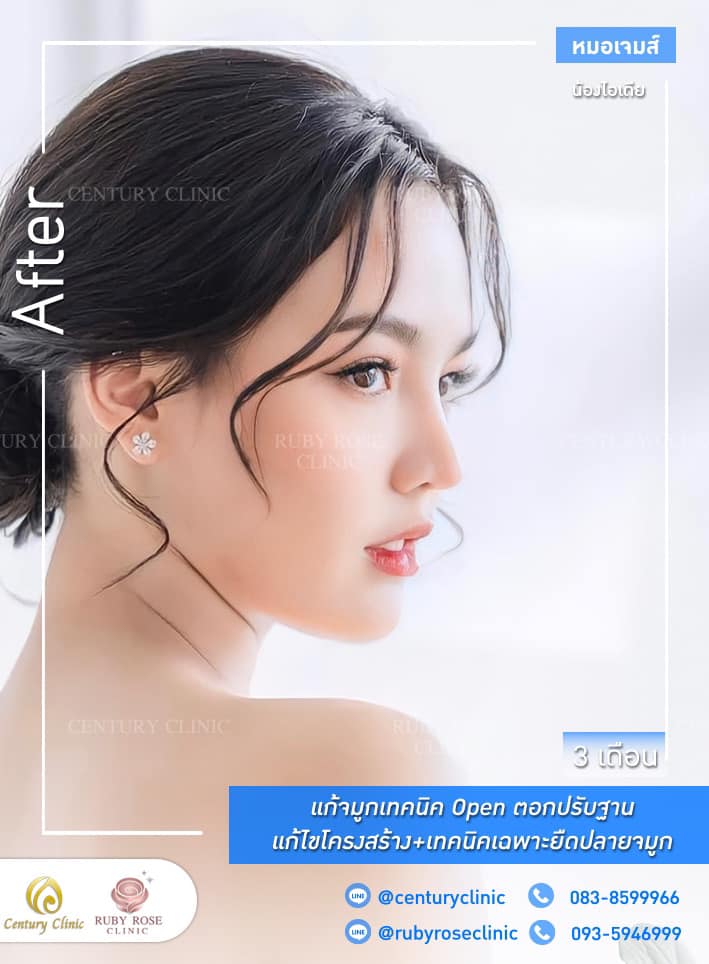Century-รีวิว-แก้จมูก #305