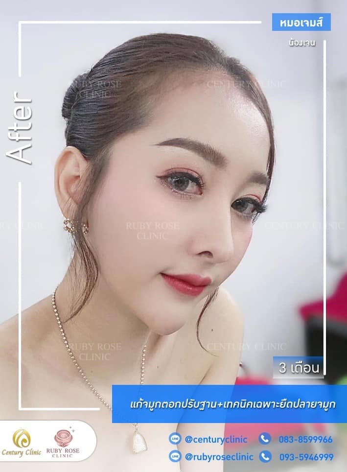 Century-รีวิว-แก้จมูก #309