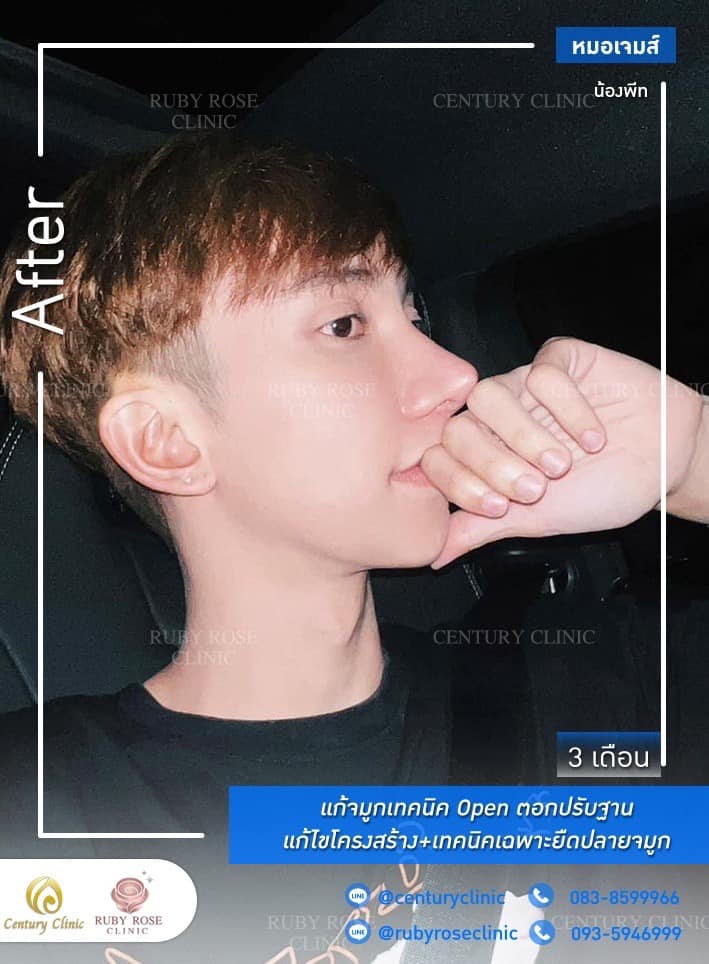 Century-รีวิว-แก้จมูก #322