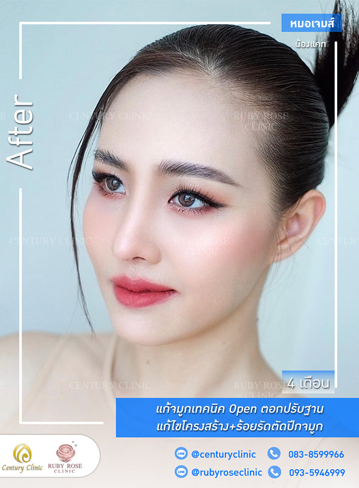 Century-รีวิว-แก้จมูก 1#329