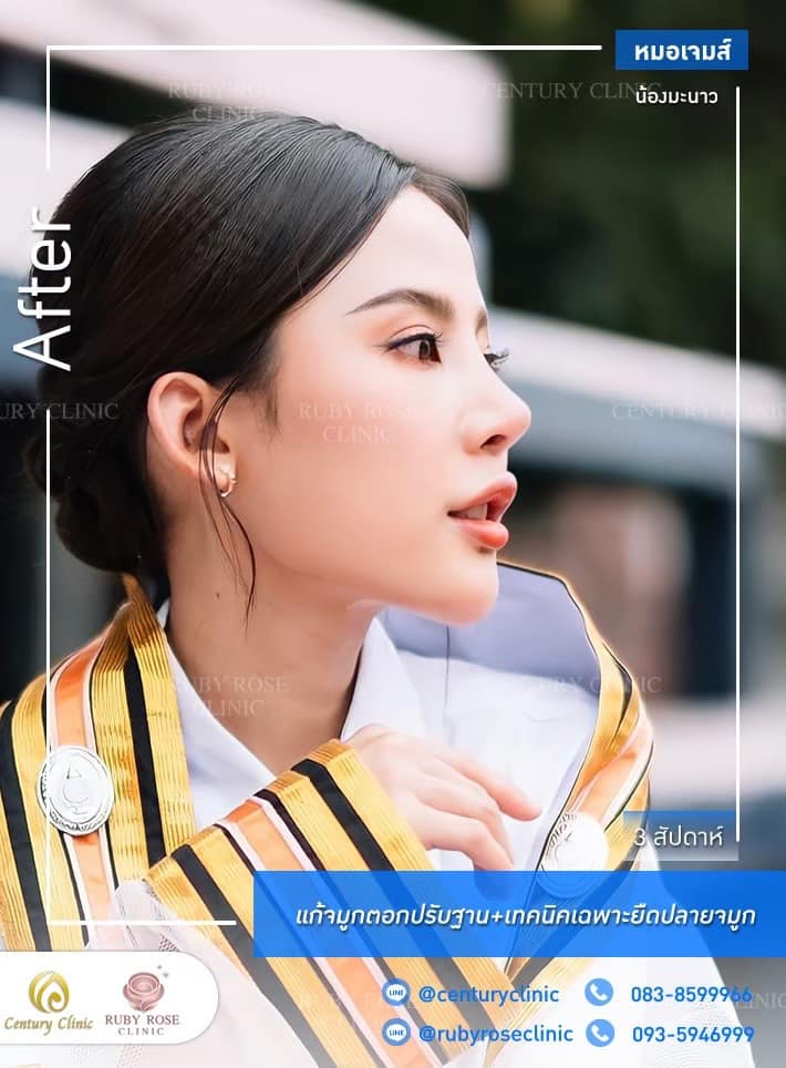 Century-รีวิว-แก้จมูก #340