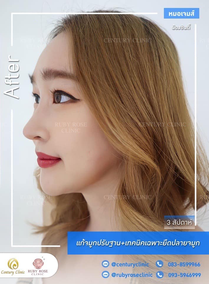 Century-รีวิว-แก้จมูก #352