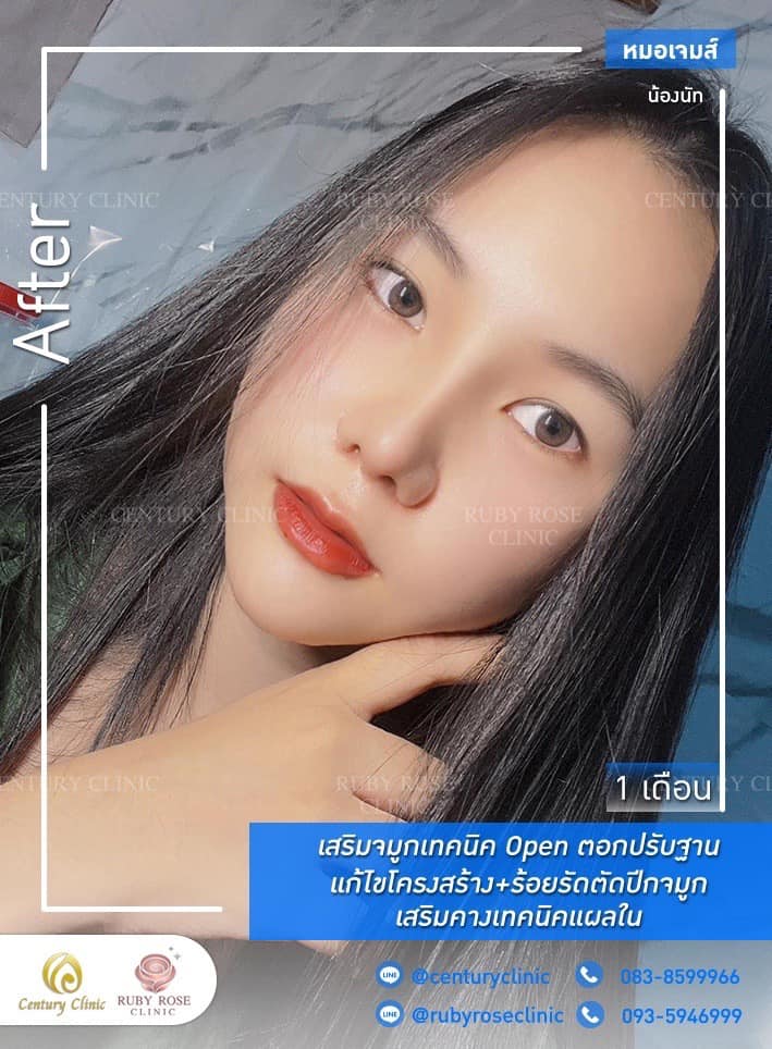 Century-รีวิว-เสริมจมูก 1#416
