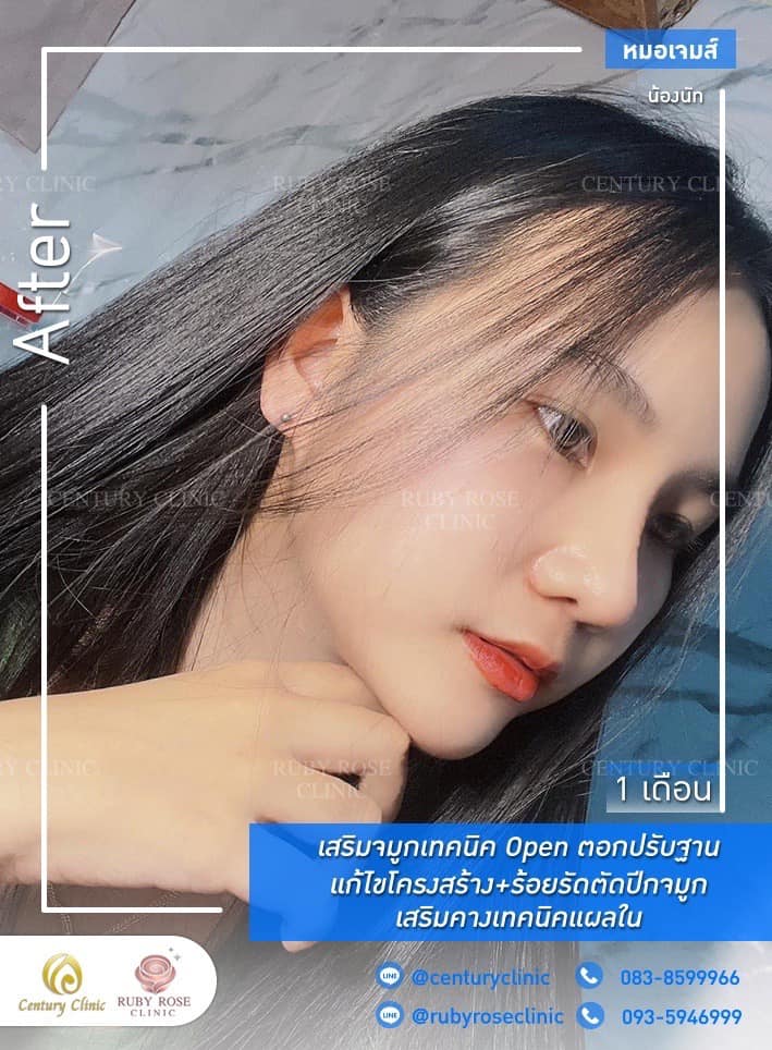 Century-รีวิว-เสริมจมูก #416