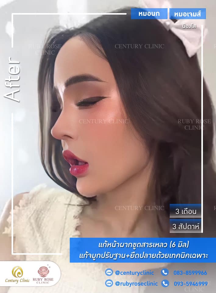 Century-รีวิว-แก้จมูก 1#376