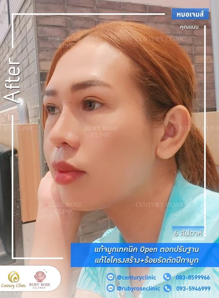 รีวิว แก้จมูก #395 , Century Clinic Thailand Century-รีวิว-แก้จมูก 1#395