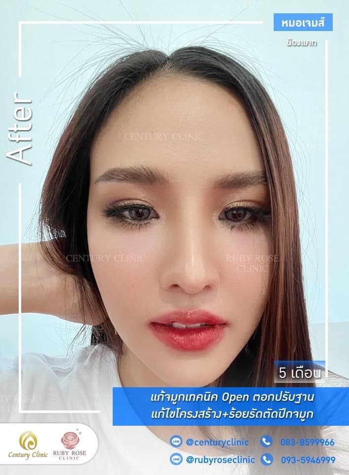 Century-รีวิว-แก้จมูก 1#400