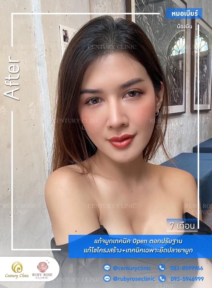 Century-รีวิว-แก้จมูก 1#415