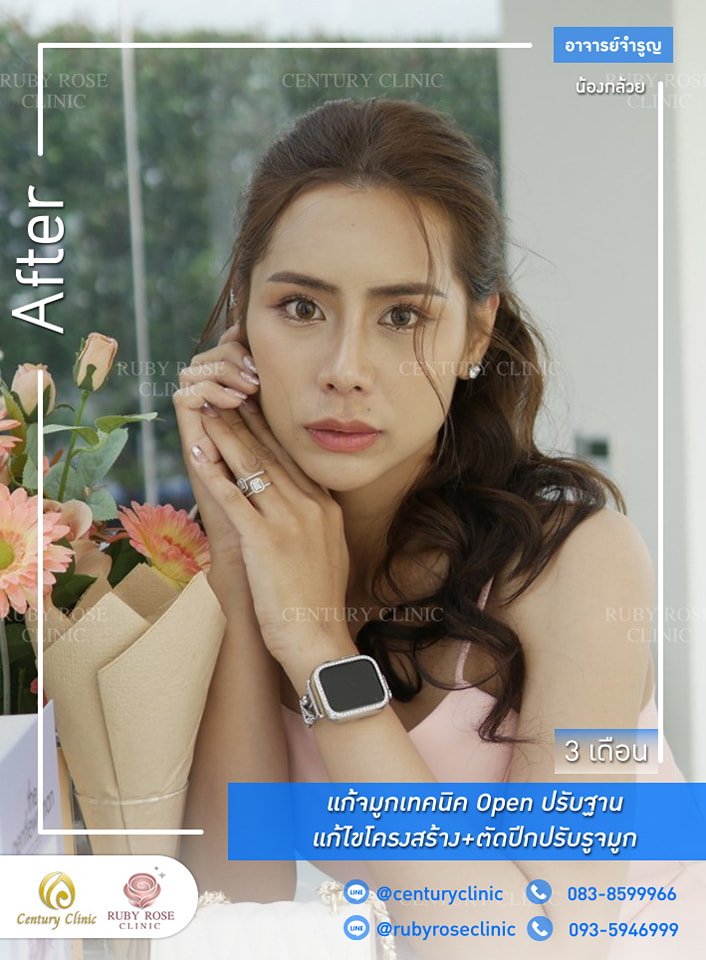 Century-รีวิว-แก้จมูก 1#419