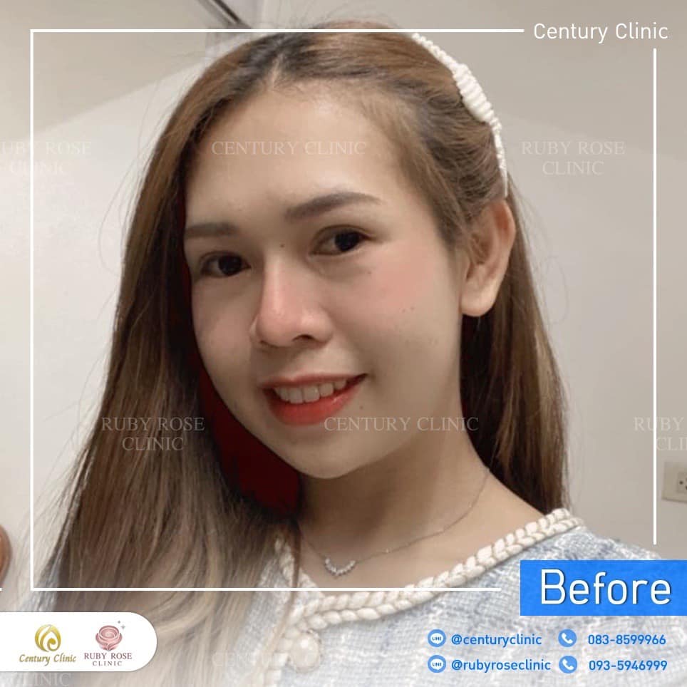 รีวิว แก้จมูก #395 , Century Clinic Thailand Century-รีวิว-แก้จมูก 2#395
