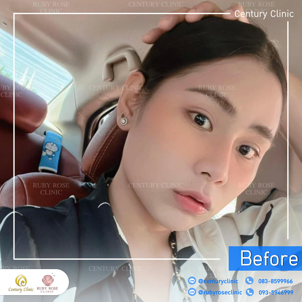 Century-รีวิว-แก้จมูก 2#419