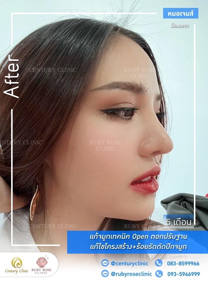 Century-รีวิว-แก้จมูก #400