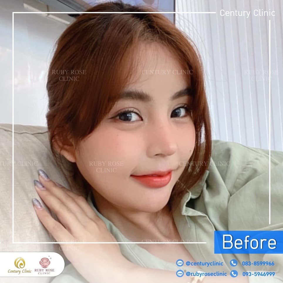 รีวิว แก้จมูก #410 , Century Clinic Thailand Century-รีวิว-แก้จมูก-คาง 2#410