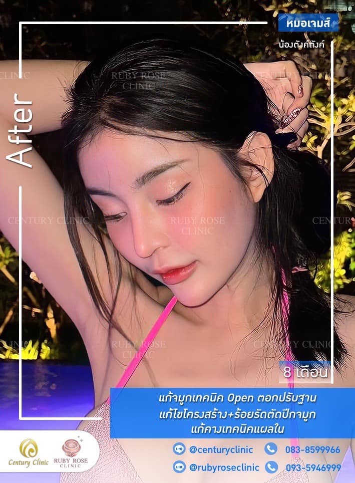 รีวิว แก้จมูก #410 , Century Clinic Thailand Century-รีวิว-แก้จมูก-คาง #410