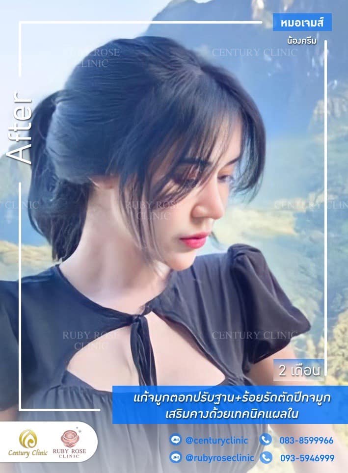 Century-รีวิว-แก้จมูก-เสริมคาง 1#390