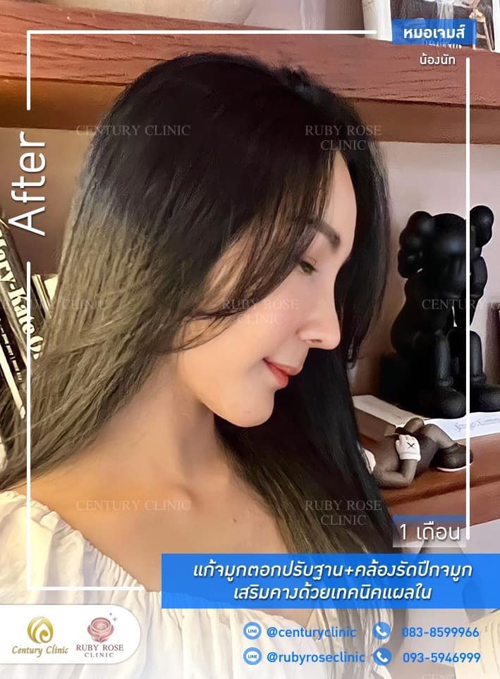 Century-รีวิว-แก้จมูก-เสริมคาง 1#420