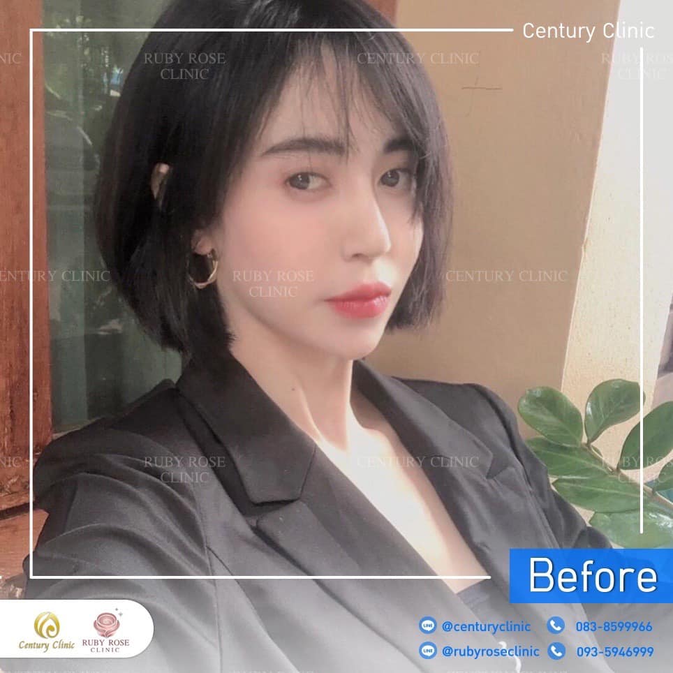 Century-รีวิว-แก้จมูก-เสริมคาง 2#390