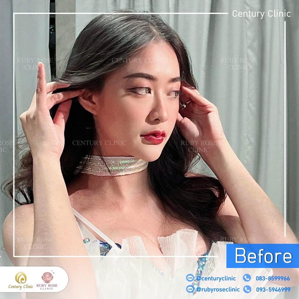 Century-รีวิว-เสริมจมูก 2#466