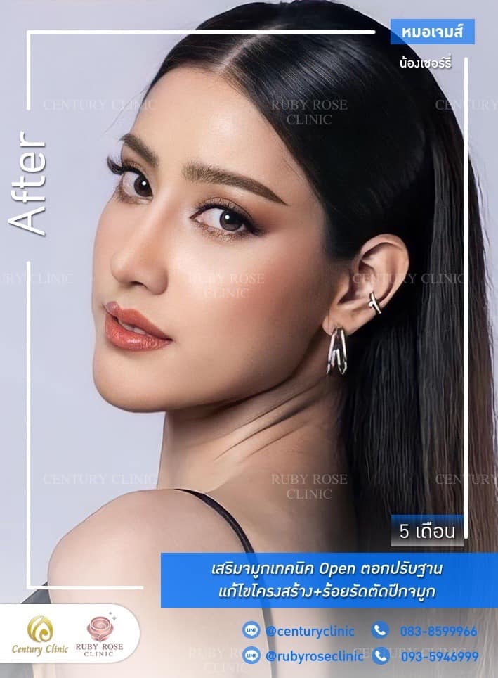Century-รีวิว-เสริมจมูก #456