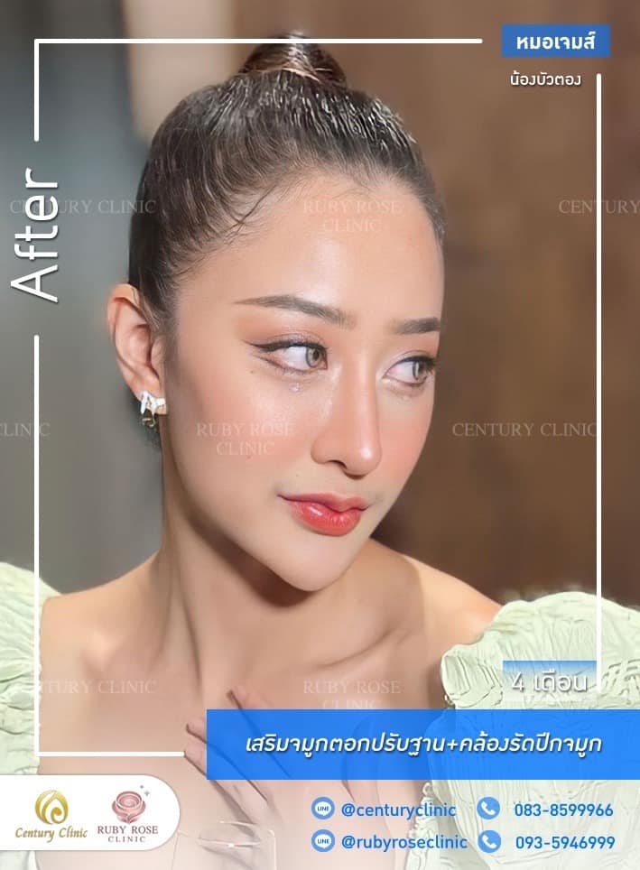 Century-รีวิว-เสริมจมูก #466