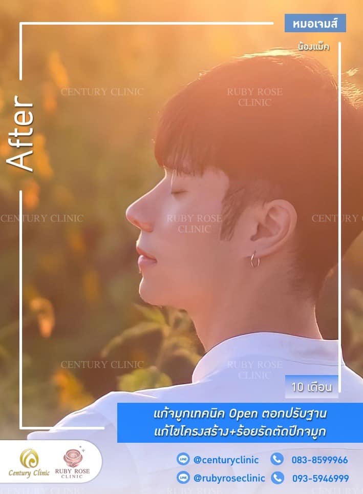 รีวิว แก้จมูก #450 , Century Clinic Thailand Century-รีวิว-แก้จมูก 1#450