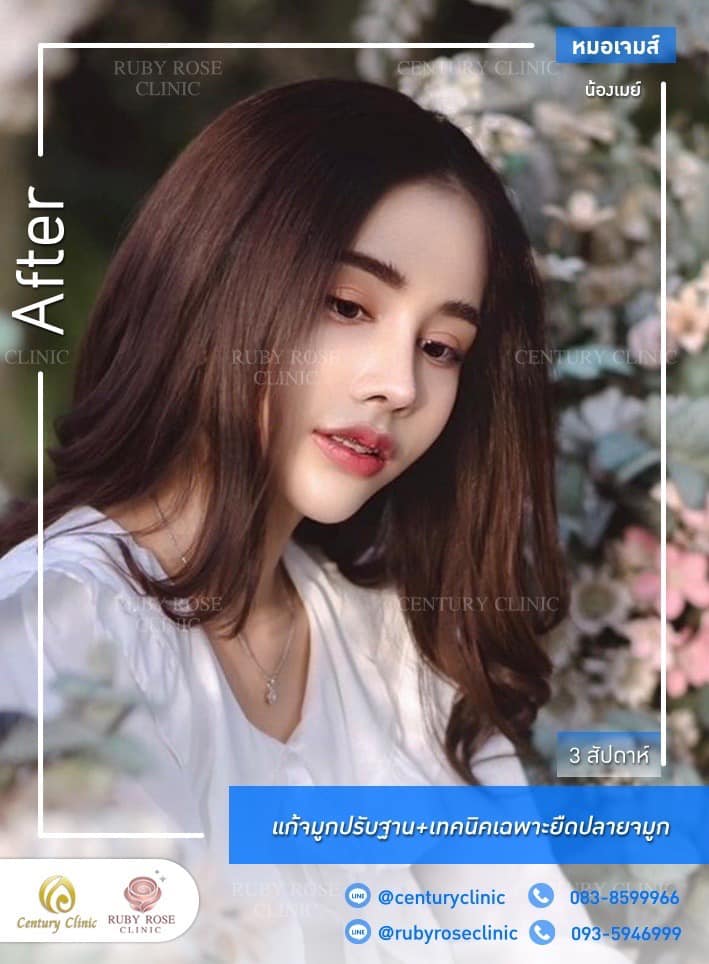 รีวิว แก้จมูก #461 , Century Clinic Thailand Century-รีวิว-แก้จมูก 1#461