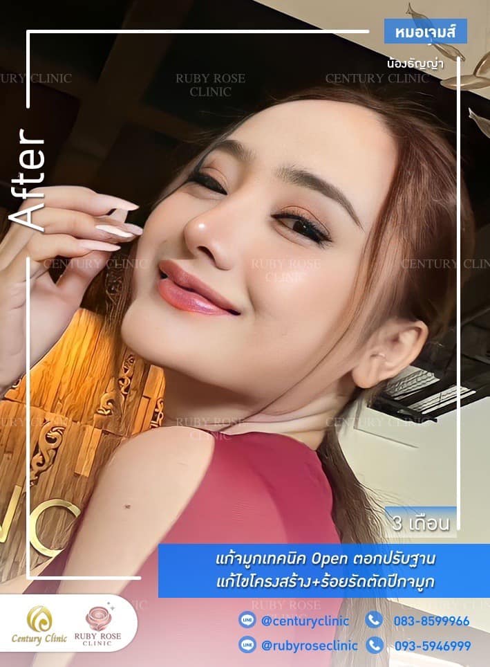Century-รีวิว-แก้จมูก 1#485