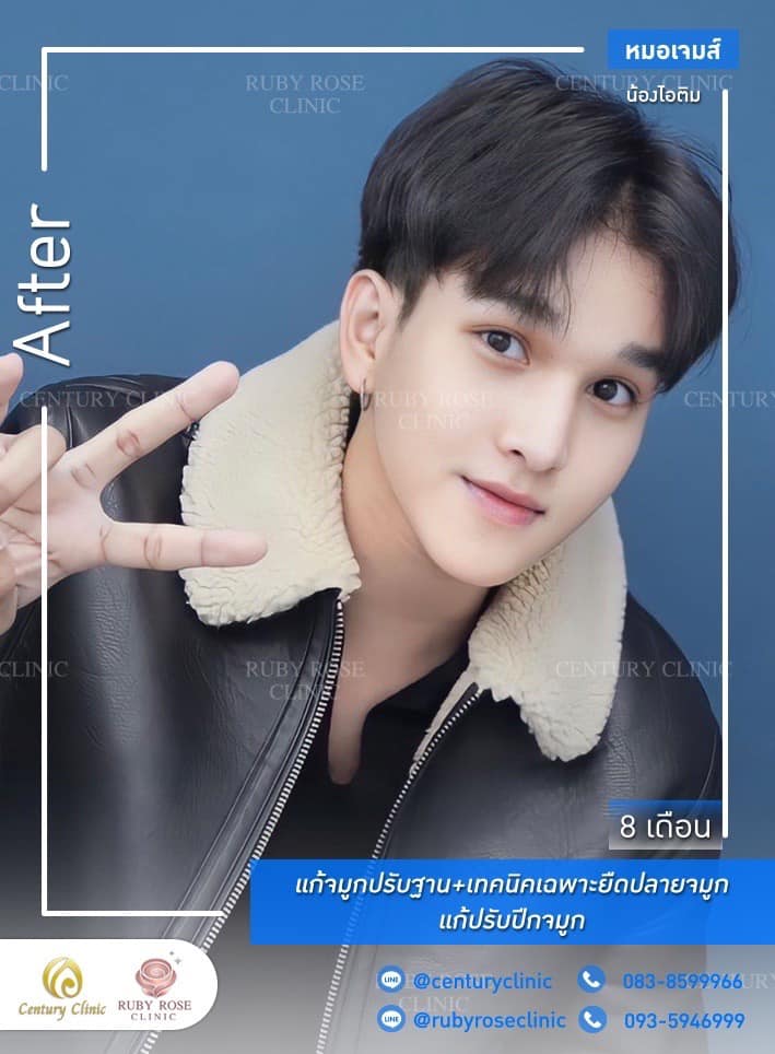 Century-รีวิว-แก้จมูก 1#509