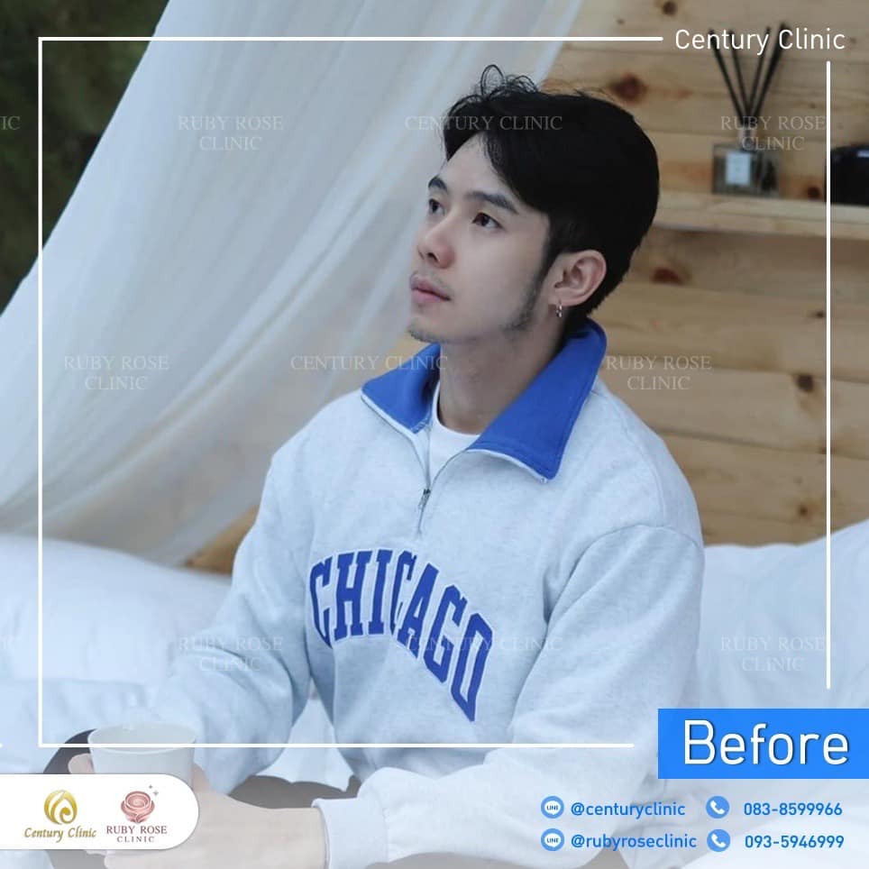 รีวิว แก้จมูก #450 , Century Clinic Thailand Century-รีวิว-แก้จมูก 2#450