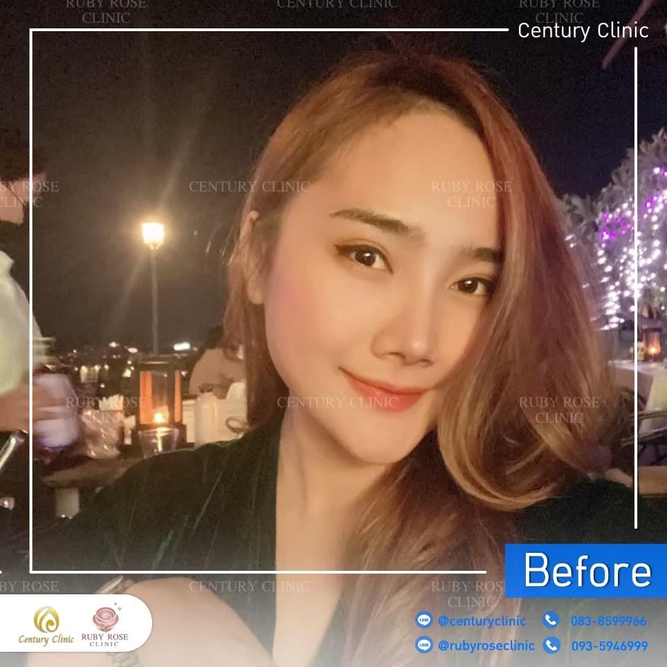 Century-รีวิว-แก้จมูก 2#485