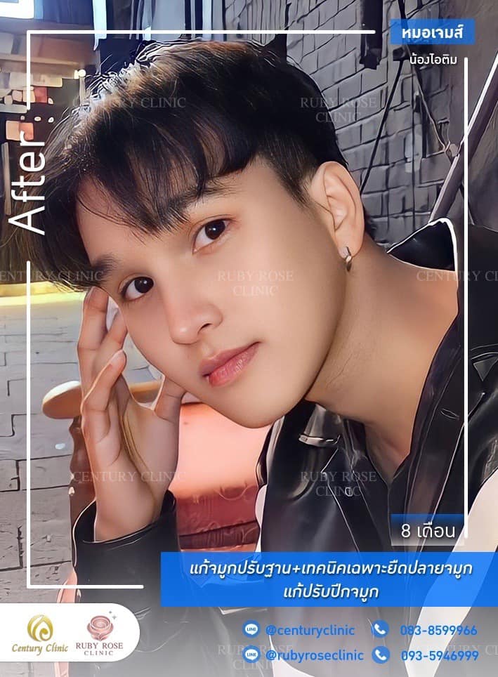 Century-รีวิว-แก้จมูก 2#509