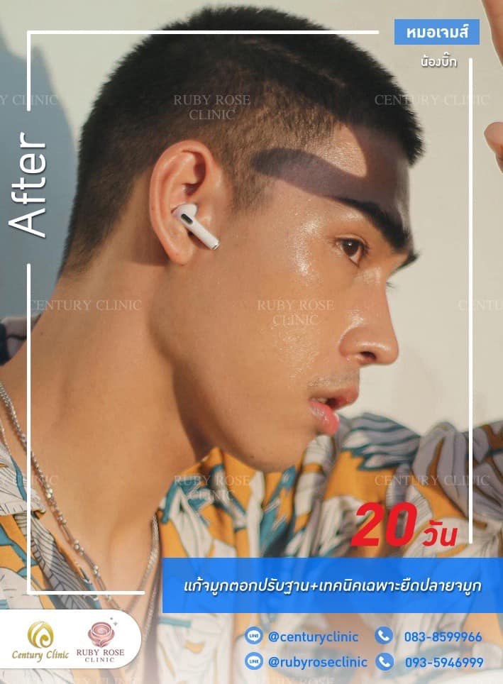 Century-รีวิว-แก้จมูก #424
