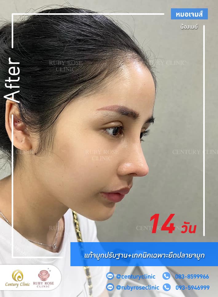 Century-รีวิว-แก้จมูก #430