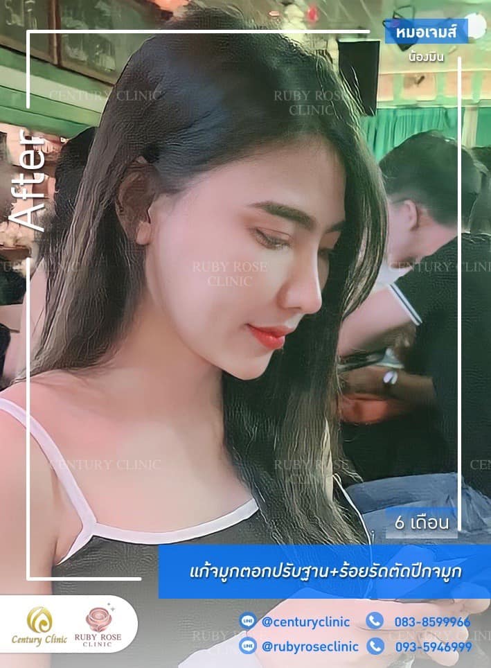 Century-รีวิว-แก้จมูก #445
